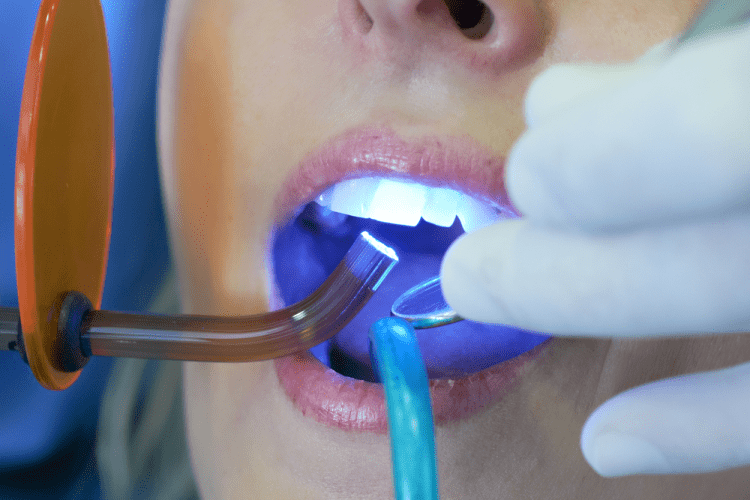 Sử dụng đèn Halogen trong điều trị trám răng 