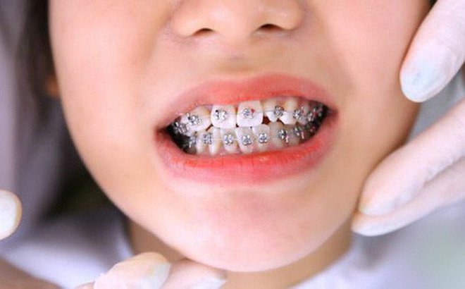 Lý do ba mẹ nên niềng răng sớm cho trẻ