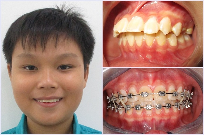 Sự thay đổi trước và sau khi niềng răng cho trẻ