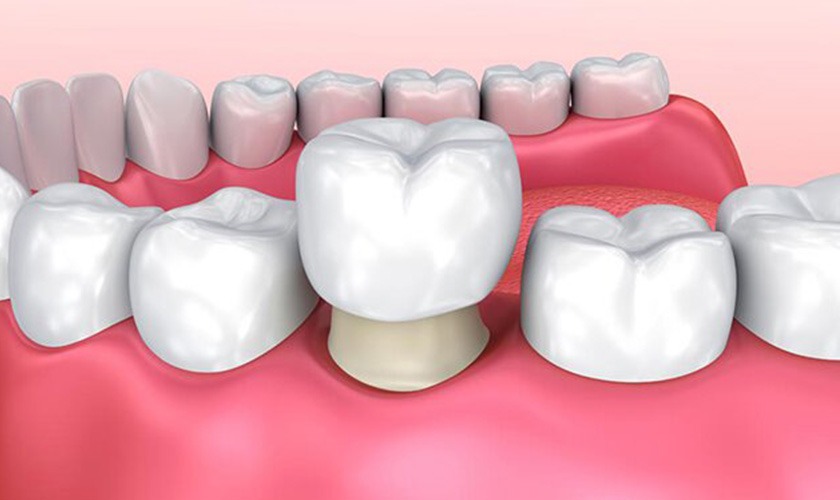 Công nghệ bọc răng sứ 4.0 là công nghệ nha khoa tiên tiến hiện đại hiện nay 