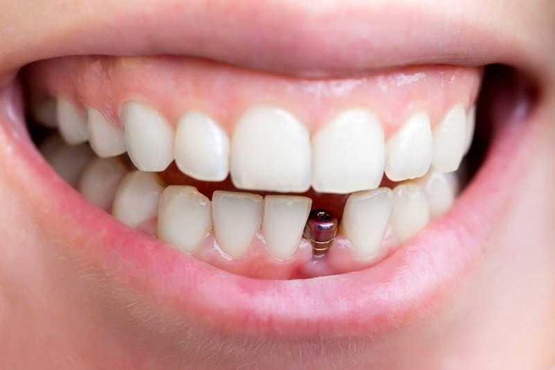  Cấy ghép Implant là công nghệ nha khoa hiện hiện đại áp dụng trong răng miệng