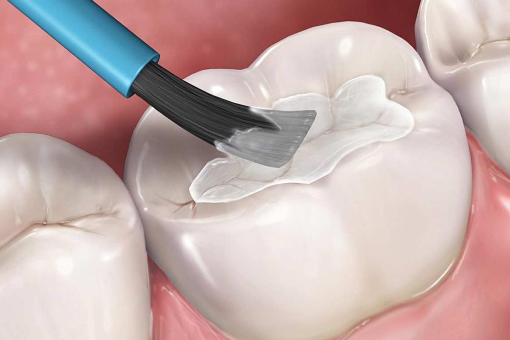 Sử dụng công nghệ trám răng để nối liền các lỗ hổng của răng 