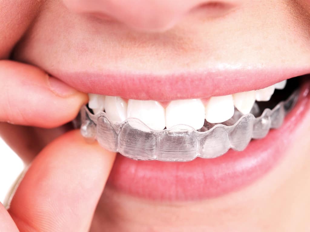  Nhờ áp dụng công nghệ số in 3D Zenyum đã đem đến khả năng niềng răng trong suốt 