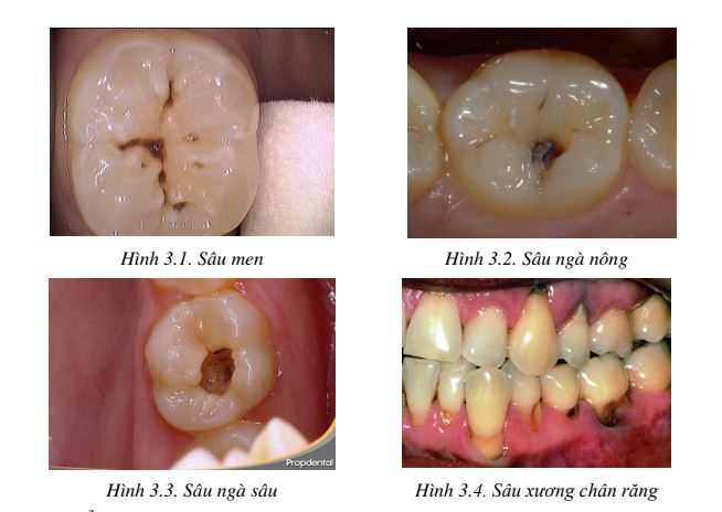 Hình ảnh các mức độ sâu răng ở trẻ em và người lớn