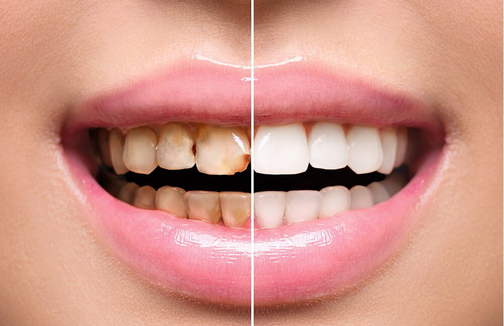 Hàm răng trước và sau điều trị bằng quá trình phục hình răng 