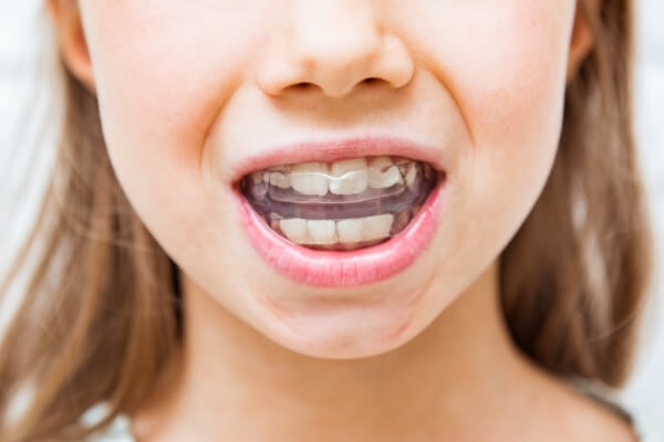 Niềng răng silicon cho bé ngày một phổ biến hiện nay
