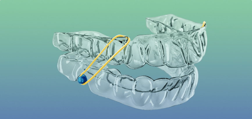 Mô hình của công nghệ niềng răng kỹ thuật số Sure Smile 