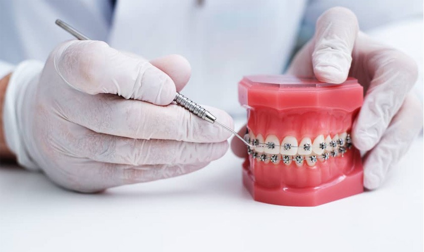 Quy trình của niềng răng kỹ thuật số 4.0 gồm 6 bước