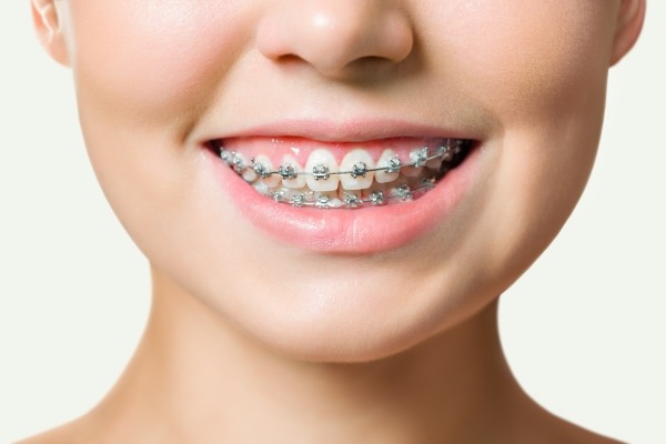  Niềng răng mắc cài là một trong những ví dụ điển hình của niềng răng truyền thống 