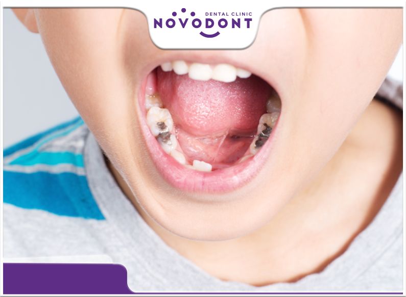 trẻ bị sâu răng đau nhức nên làm gì