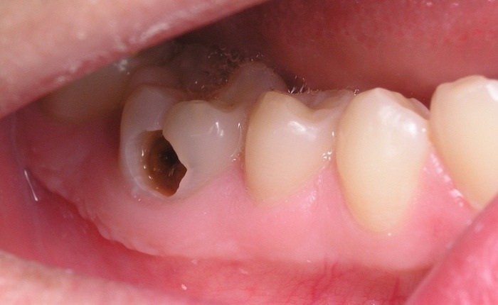 Hình ảnh trẻ bị sâu răng hàm