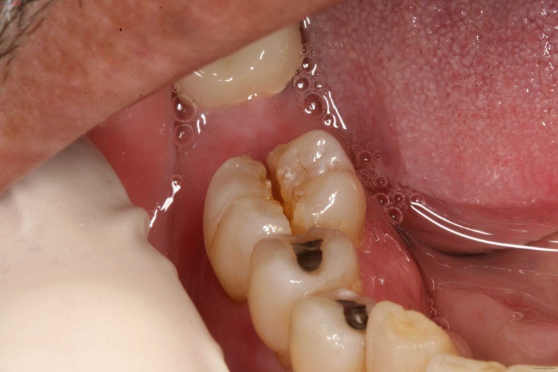 Trẻ bị sâu răng hàm ảnh hưởng đến hoàn thiện cấu trúc răng