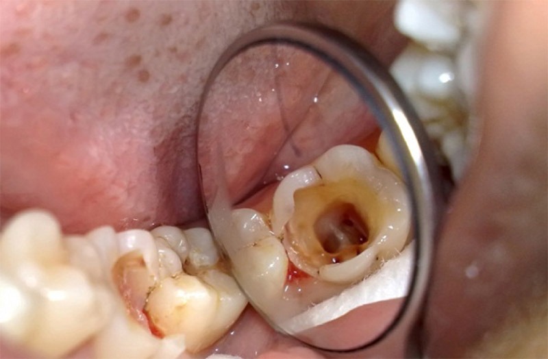 Răng hàm bị sâu vào tủy