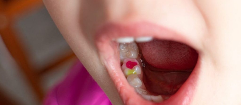 Có nên trám răng cho trẻ không? Nếu răng bé bị sâu, sún, sứt mẻ trong một số trường hợp nghiêm trọng cần phải trám răng