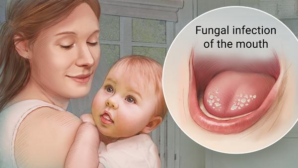 Trẻ bị nấm miệng cũng có thể do ti mẹ hoặc ti giả có nhiễm vi khuẩn