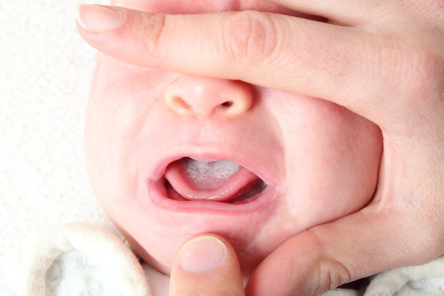 Trẻ xuất hiện mảng màu trắng trong lưỡi khi bị nấm miệng
