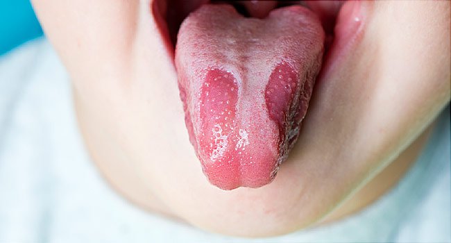 Đánh giá của các bác sĩ, sau khoảng thời gian 1 tuần đến 1 tháng, nấm miệng sẽ khỏi nếu được điều trị đúng cách