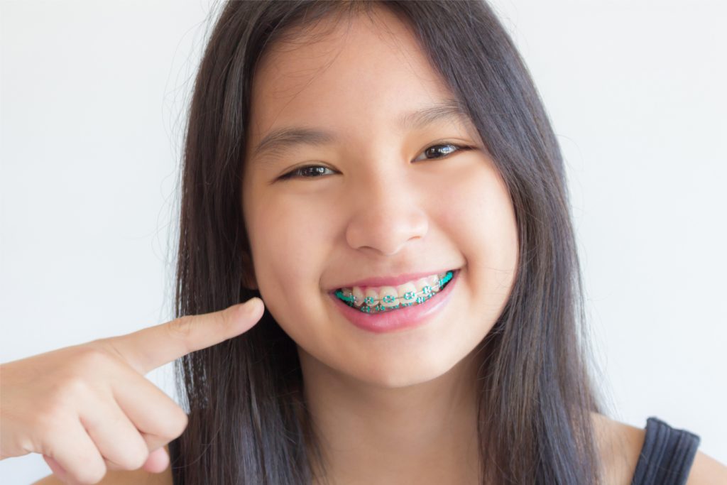 Niềng răng là  một trong những phương án điều trị phổ biến khi răng trẻ mọc lệch