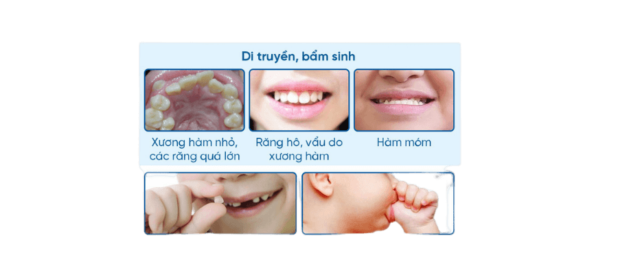 Nguyên nhân răng trẻ mọc lệch