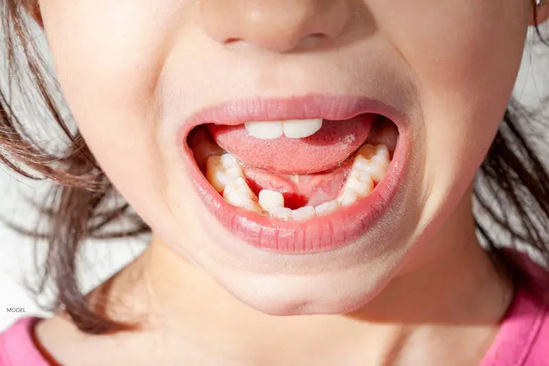 Có thể điều trị răng mọc lệch ở trẻ em bằng chỉnh nha