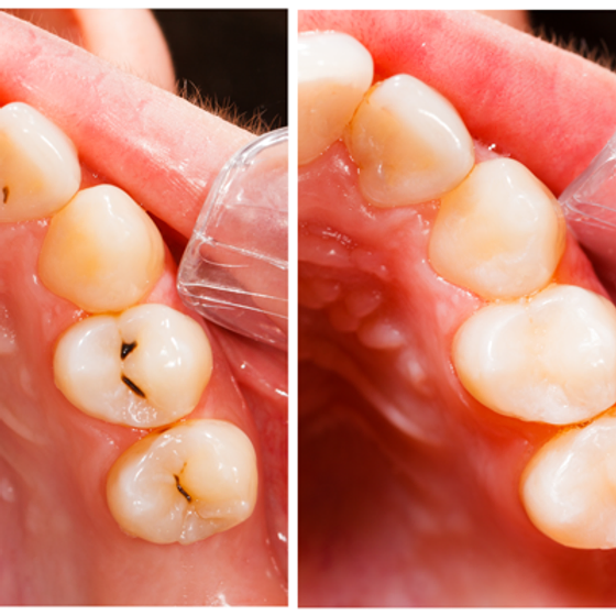 Dấu hiệu nhận biết răng vĩnh viễn của trẻ bị sâu