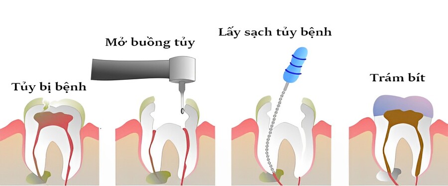 Quá trình điều trị tủy bị viêm do sâu răng