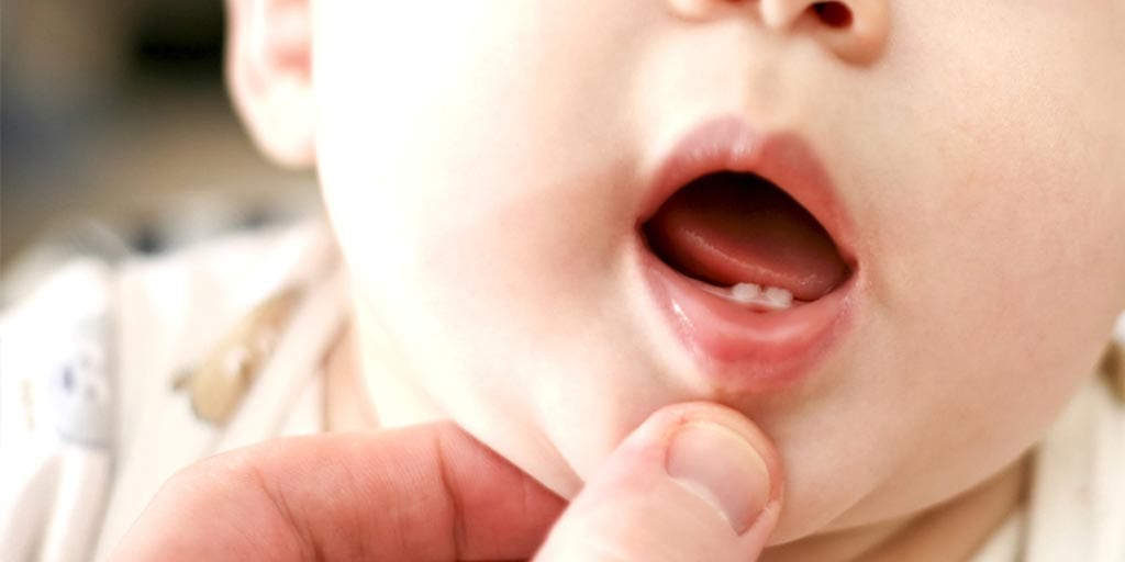 Bé chậm mọc răng có thể do còi xương, phụ huynh nên chú ý bổ sung đủ chất dinh dưỡng cho trẻ