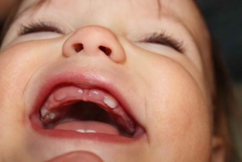 Trẻ bắt đầu mọc răng nanh vào thời điểm khoảng 16 tháng tuổi