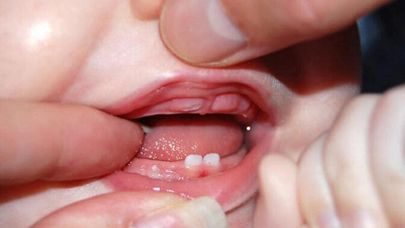 Trẻ mọc răng sớm nhất là mấy tháng? 