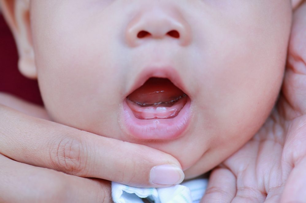 Thời điểm mọc răng sữa, bé có thể bị sốt, quấy khóc, phụ huynh  chú ý để chăm sóc bé đúng cách