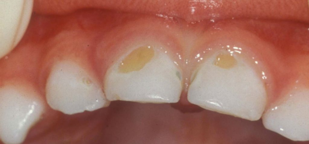 Dấu hiệu răng sữa của trẻ bị sâu