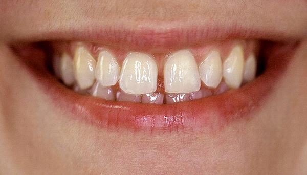 Răng thưa là nguyên nhân lớn làm lệch hàm, phát âm không chuẩn (ngọng), khó vệ sinh răng miệng và còn tăng nguy cơ mắc các bệnh lý về răng miệng.
