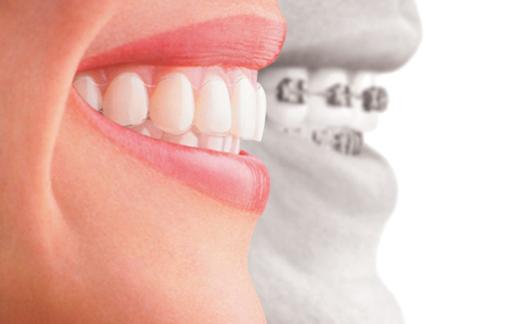 Bị lệch hàm có niềng răng được không? Niềng răng là phương pháp phổ biến điều trị các vấn đề lệch hàm