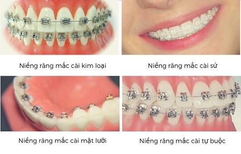 Một số phương pháp niềng răng mắc cài