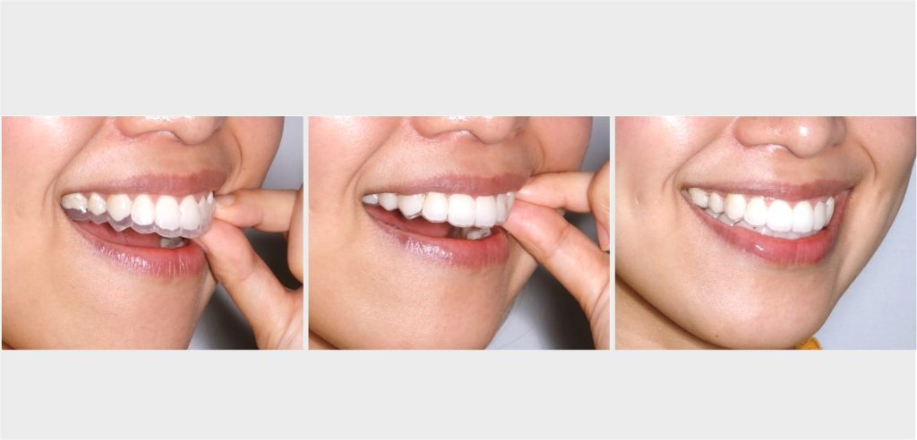 Bạn cần thay khay ít nhất 45 lần để có hàm răng hoàn hảo 