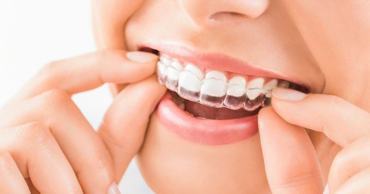 Niềng răng trong suốt là phương pháp chỉnh nha có tính thẩm mỹ, linh hoạt cao