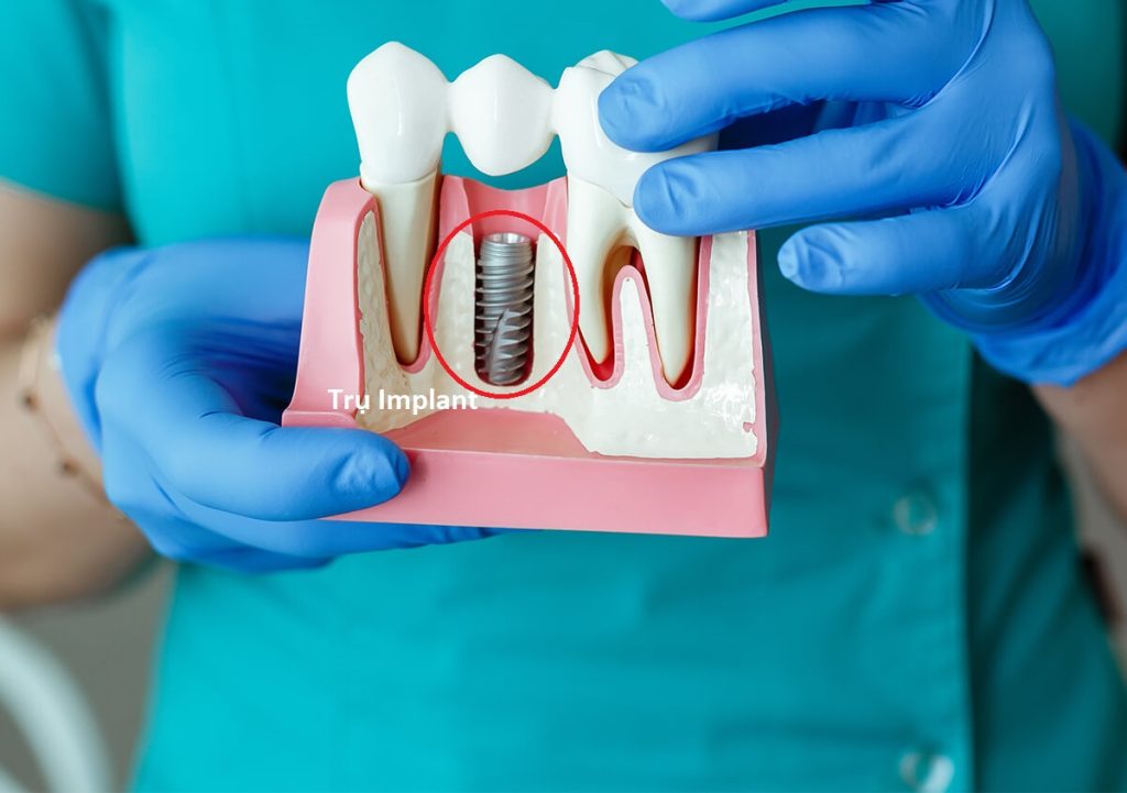 Trụ Implant có tác dụng như một nền móng răng vững chắc