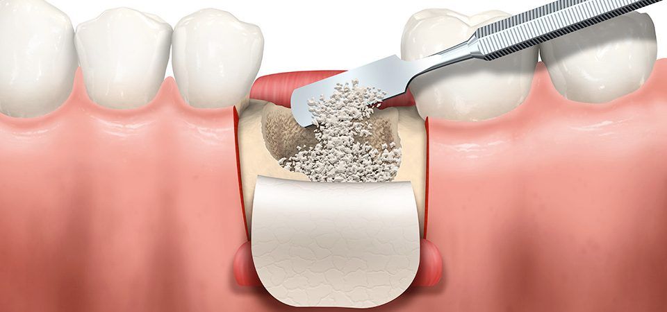  Kỹ thuật ghép ổ xương răng trong trồng răng Implant 