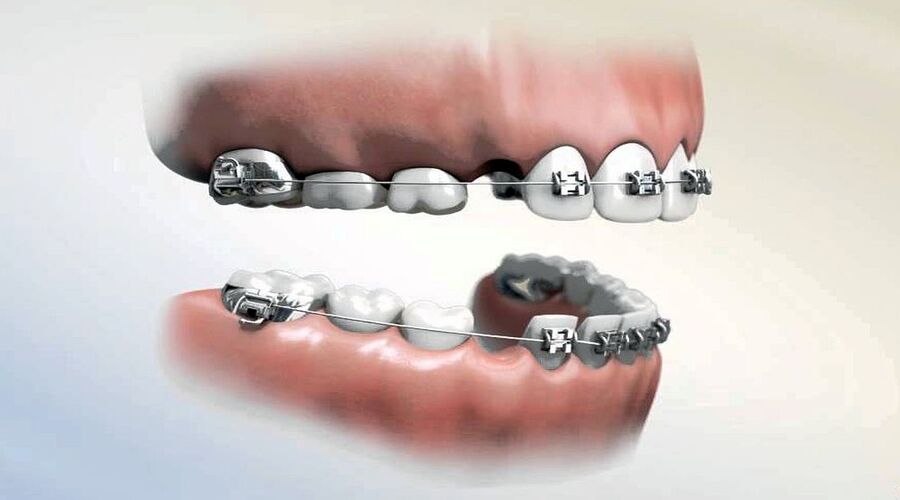 Để tạo khoảng trống dịch chuyển khi niềng răng, nhổ răng số 4 không phải là phương án duy nhất