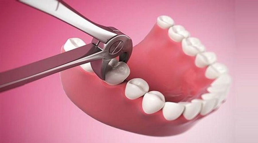 Răng số 4 là răng có ít chức năng nhai, vì vậy nhổ răng số 4 là phương án an toàn và hợp lý, ít biến chứng