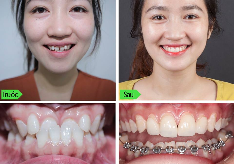 Hình ảnh trước và sau khi niềng răng 