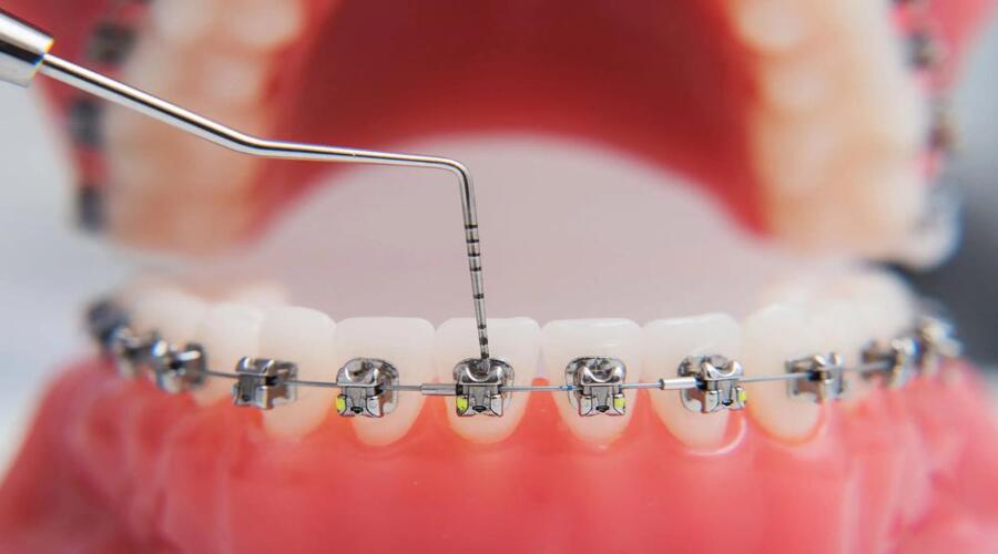 Gắn mắc cài bao lâu thì nhổ răng? Thông thường thời gian nhổ răng sau khi gắn mắc cài là 1-2 tháng
