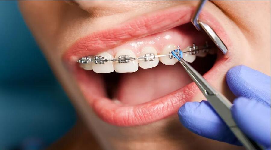 - Tùy thuộc vào tình trạng răng bác sĩ sẽ khuyến nghị gắn mắc cài trước hay nhổ răng trước