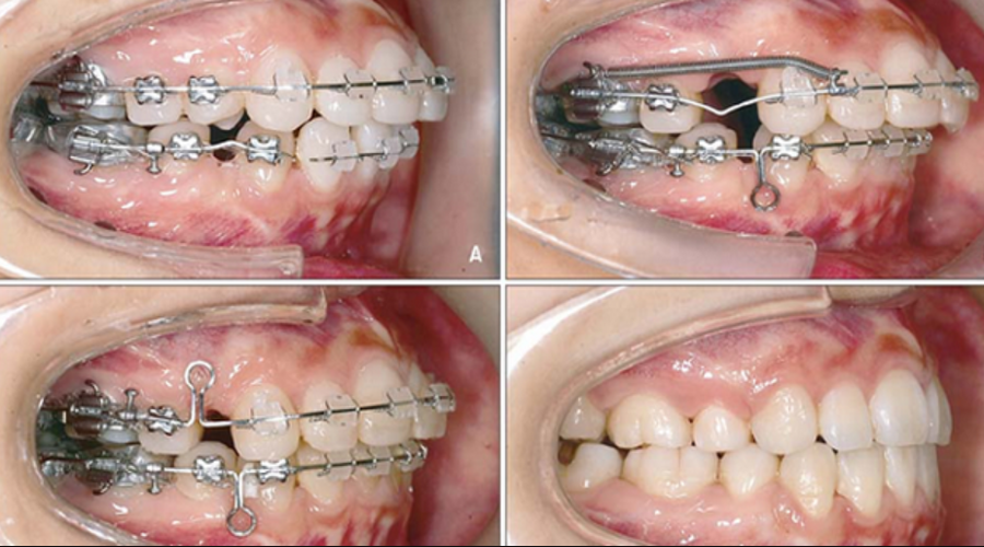 Trường hợp răng phải nhổ trước khi gắn mắc cài để quy trình niềng dễ dàng 