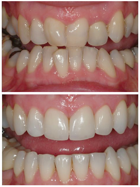 Hình ảnh trước và sau khi niềng răng khấp khểnh