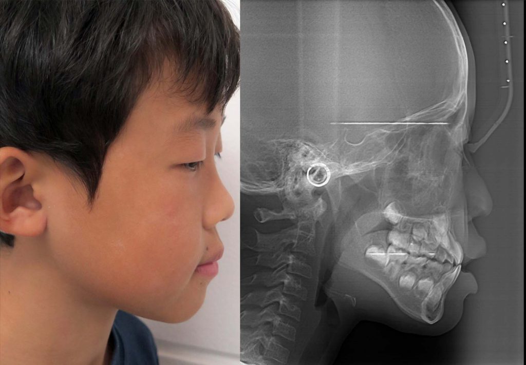 Ảnh chụp X-quang của một bạn nhỏ bị hô hàm nhẹ 