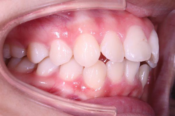 Răng hô là một dạng sai lệch về khớp cắn khiến cho tỷ lệ tương quan giữa hàm trên với hàm dưới có sự mất cân đối
