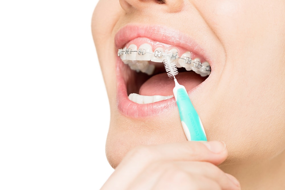 Bạn nên tìm hiểu chi tiết cách vệ sinh răng miệng, loại bàn chải, loại kem đánh răng dùng trong chỉnh nha 