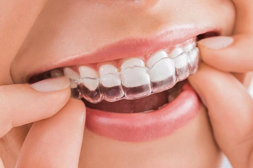Niềng răng có làm răng yếu đi nếu bạn không biết cách  chăm sóc và bảo vệ răng miệng