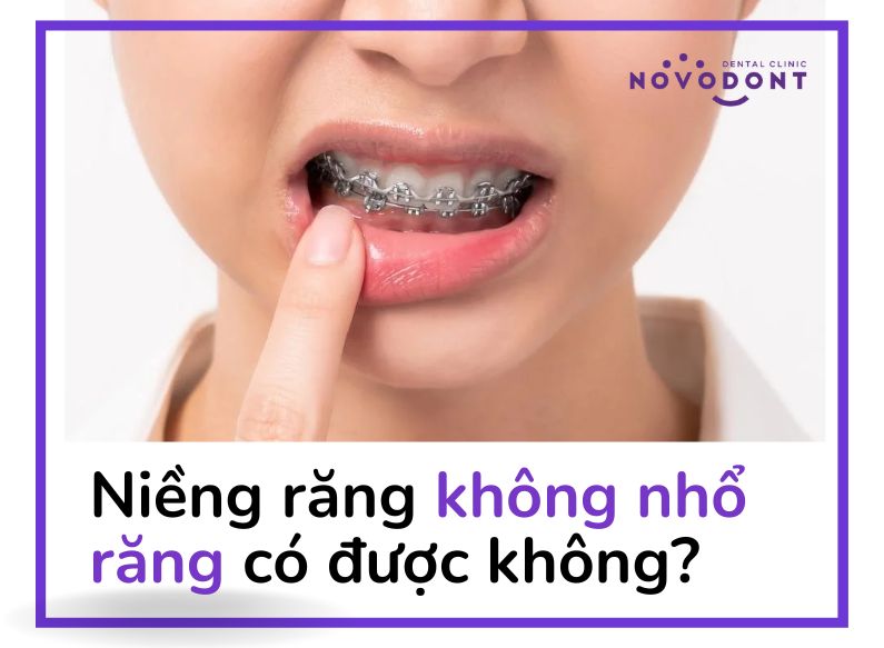 Niềng răng không nhổ răng có được không?